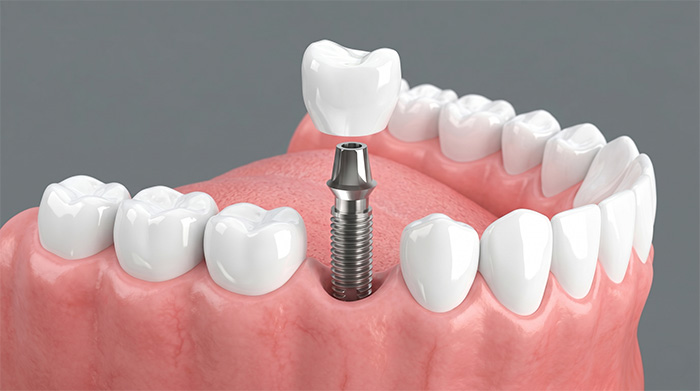 上部構造（人工歯）の装着